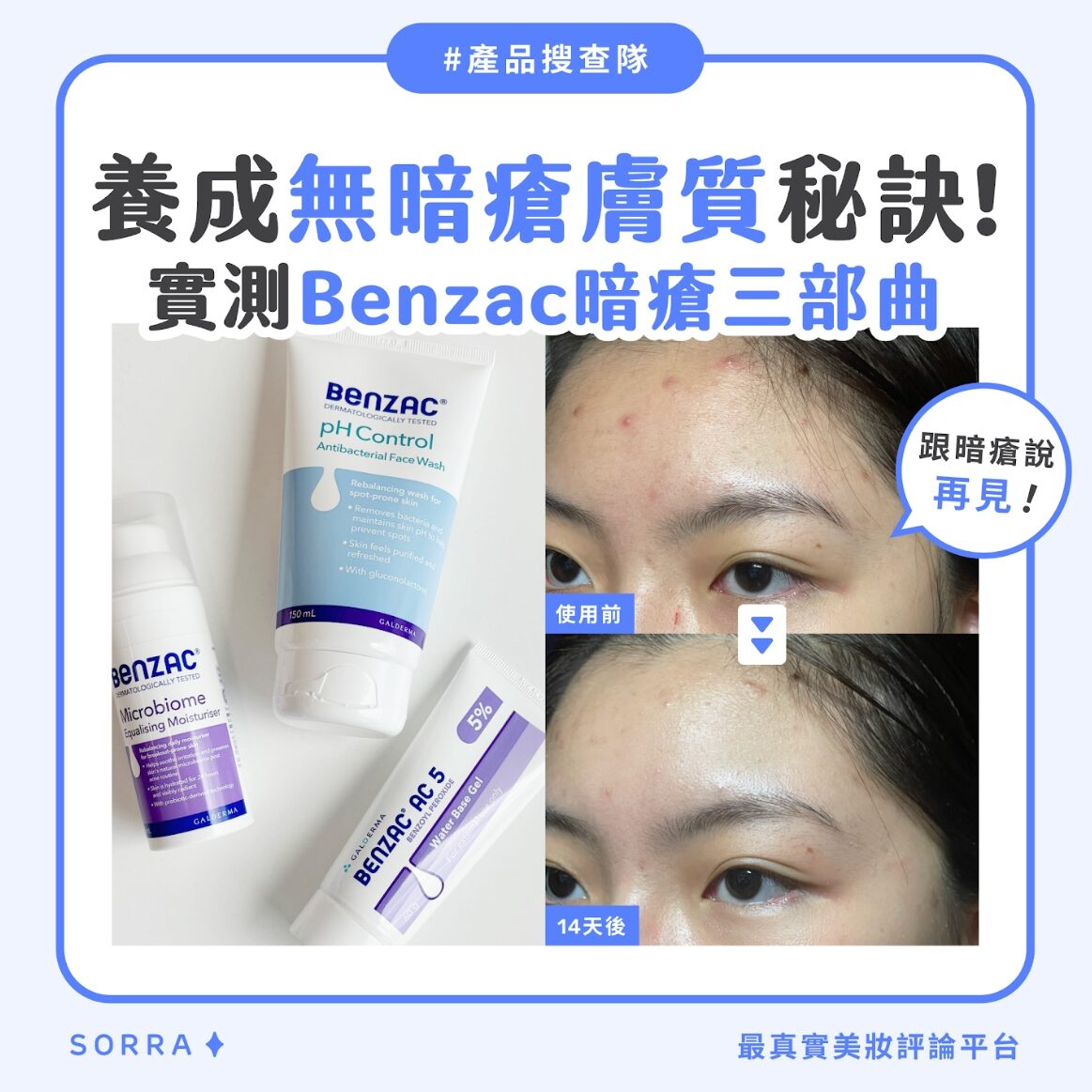 #SORRA產品搜查隊 養成無暗瘡膚質秘訣！實測Benzac暗瘡三部曲！